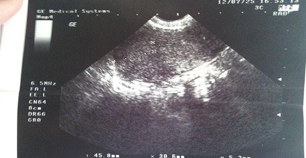 出B超报告单的时间