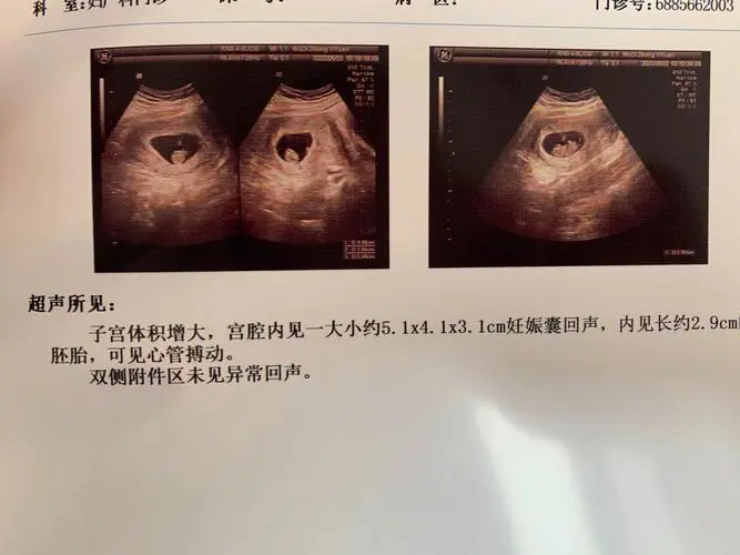 宫腔积液对试管移植的这些影响你需要了解