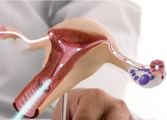 五个步骤带你了解试管移植手术全过程