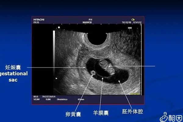 妊娠囊