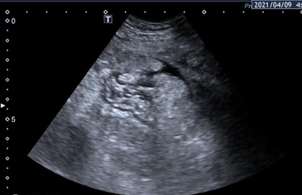 卵巢过度刺激会引起腹水