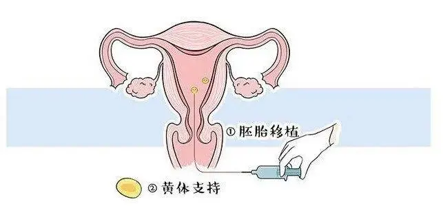 试管婴儿移植后这七点注意事项不可大意