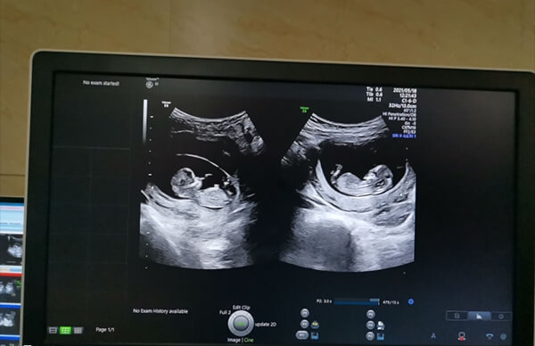 试管婴儿生育双胞胎风险大