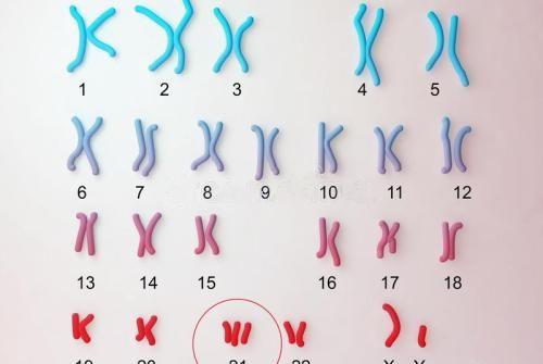 唐氏综合征染色体特征
