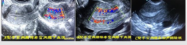 不同形态子宫内膜实图